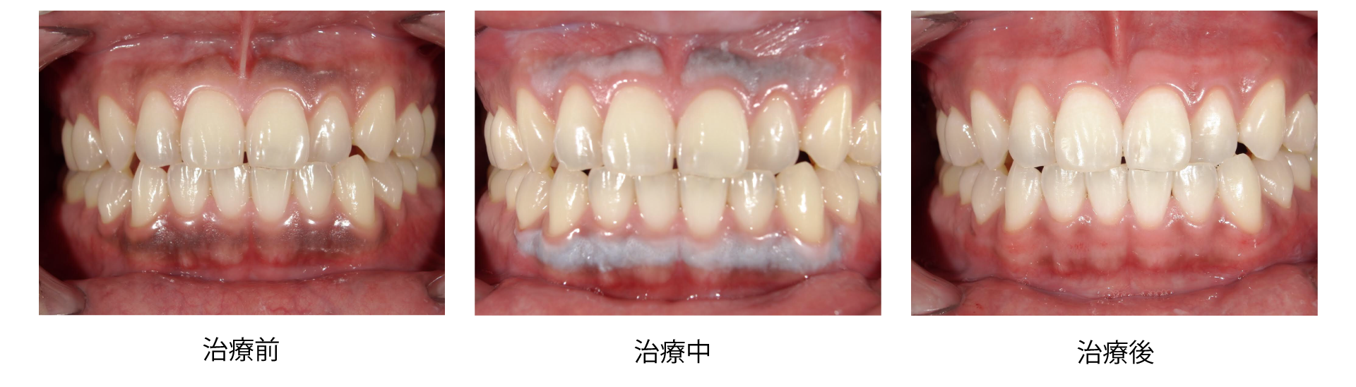 ガムピーリング 上野医院 歯科診療所